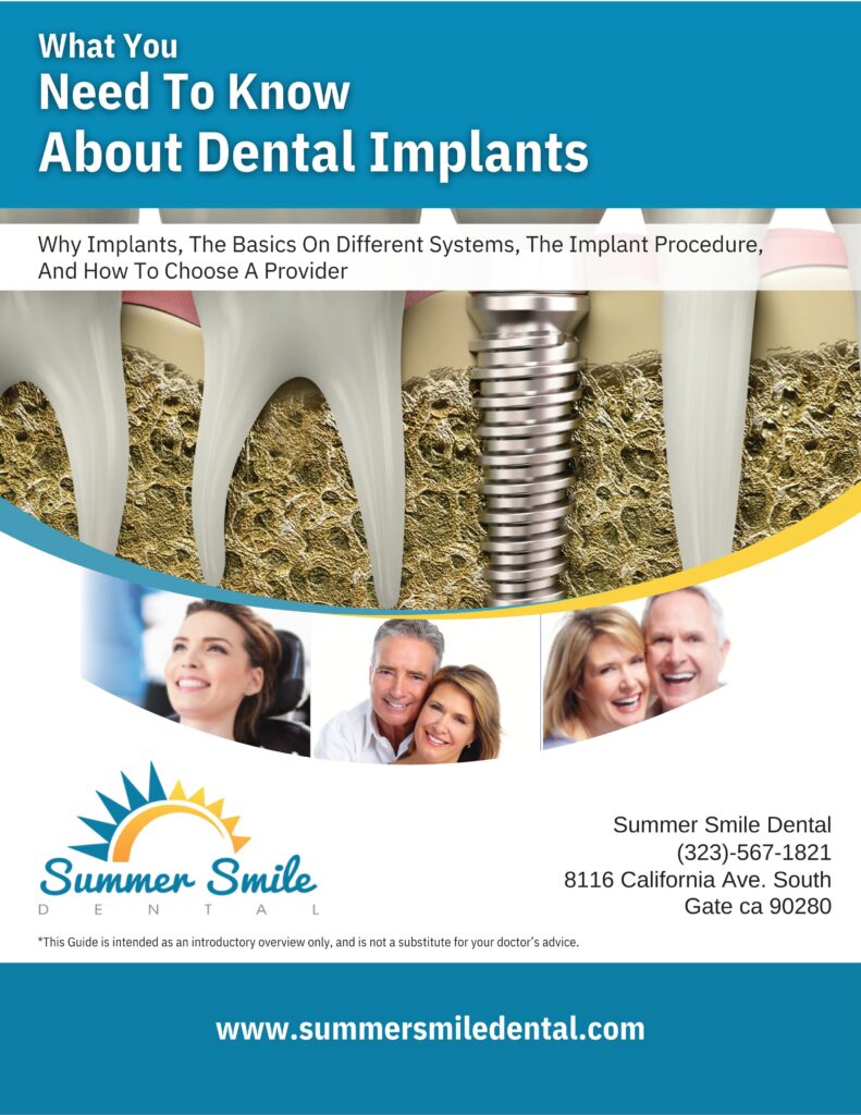 implan guide- summer smile dental